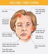 XOA BÓP - BẤM HUYỆT  ĐIỀU TRỊ LIỆT DÂY THẦN KINH VII NGOẠI BIÊN