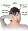 HIỆU QUẢ  ĐIỀU TRỊ THOÁI HOÁ CỘT SỐNG CỔ  BẰNG PHƯƠNG PHÁP XOA BÓP BẤM HUYỆT