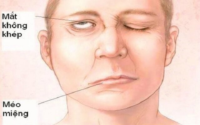 Chăm sóc mắt ở người bệnh Liệt VII ngoại biên
